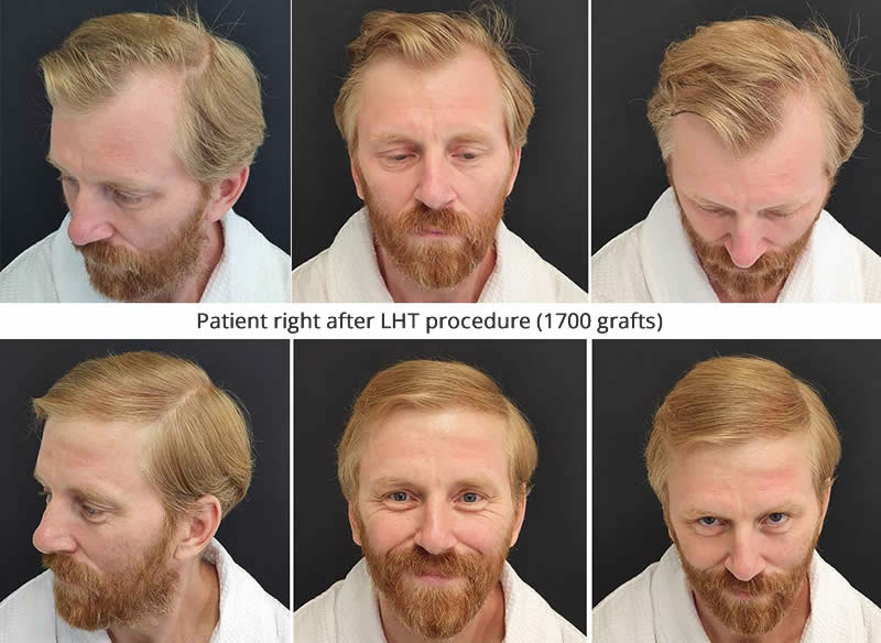 Dr. Akaki Tsilosani  - Male hair loss