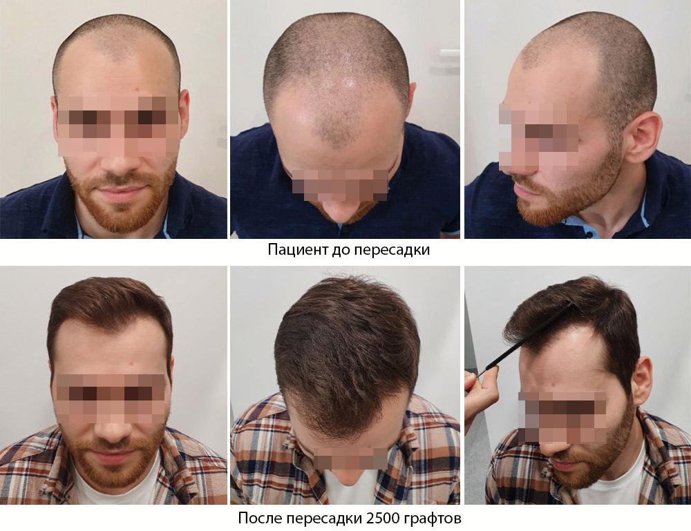 Gересадке волос бесшовным методом -  до и после. Проф. Акакий Цилосани