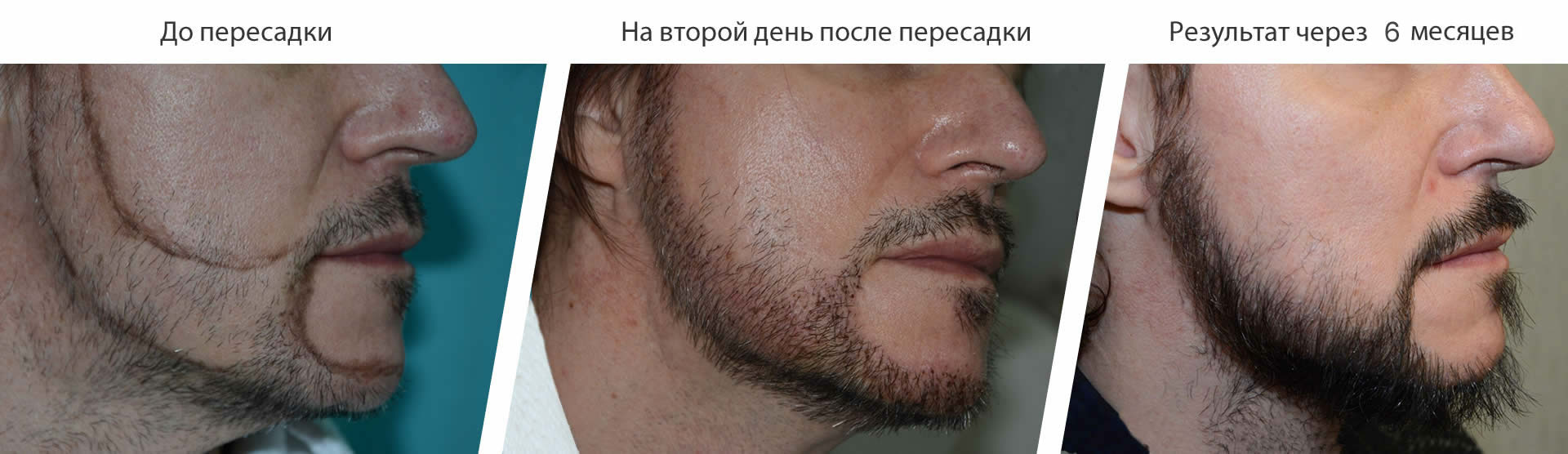 Пересадка волос в бороду - до и после. Проф. Акакий Цилосани