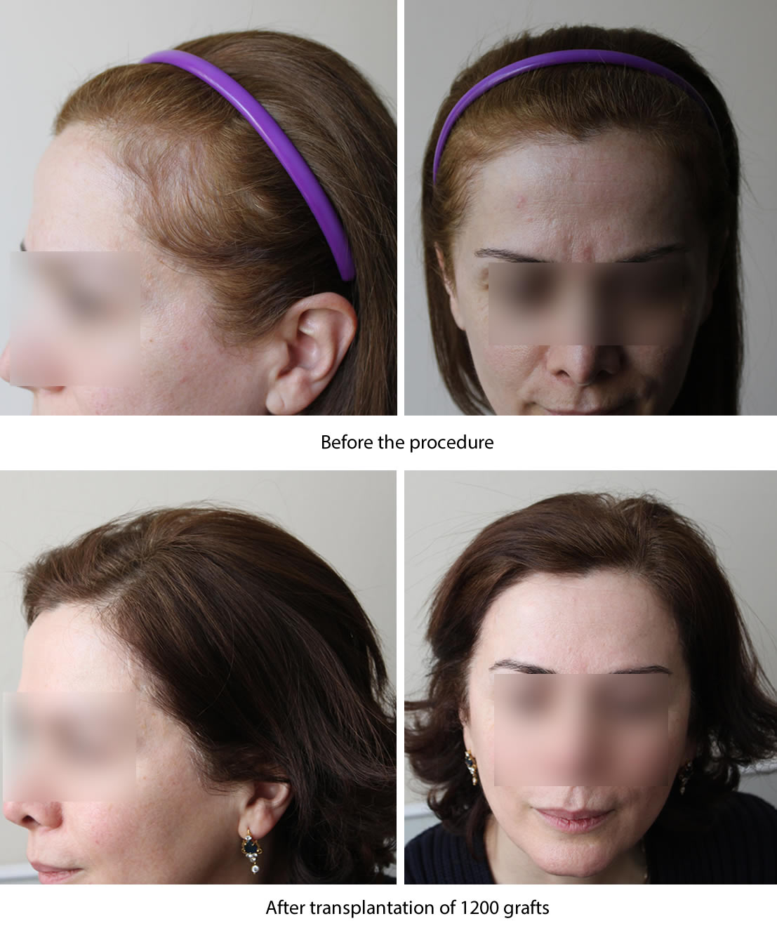 Female hair restoration results -   before and after. Dr Akaki Tsilosani, MD, PhD, FISHRS