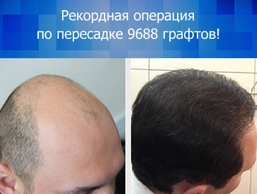 Цилосани - рекордная пересадка - 9688 графтов!