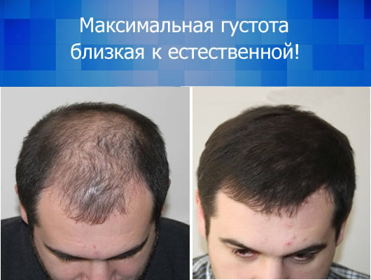Цилосани - максимальная густота