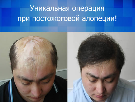 Цилосани - постожоговая алопеция