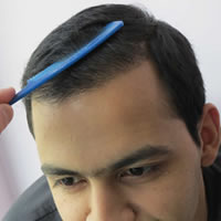 Crypto in hair transplantation