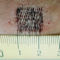 Crypto in hair transplantation