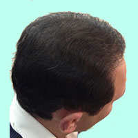 Crypto in hair transplantation