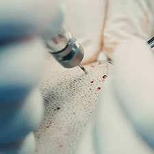 Crypto in hair transplantation
