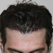 Crypto in hair transplantation
