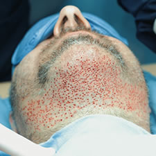 Crypto in hair transplantation