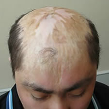 Crypto in hair transplantation