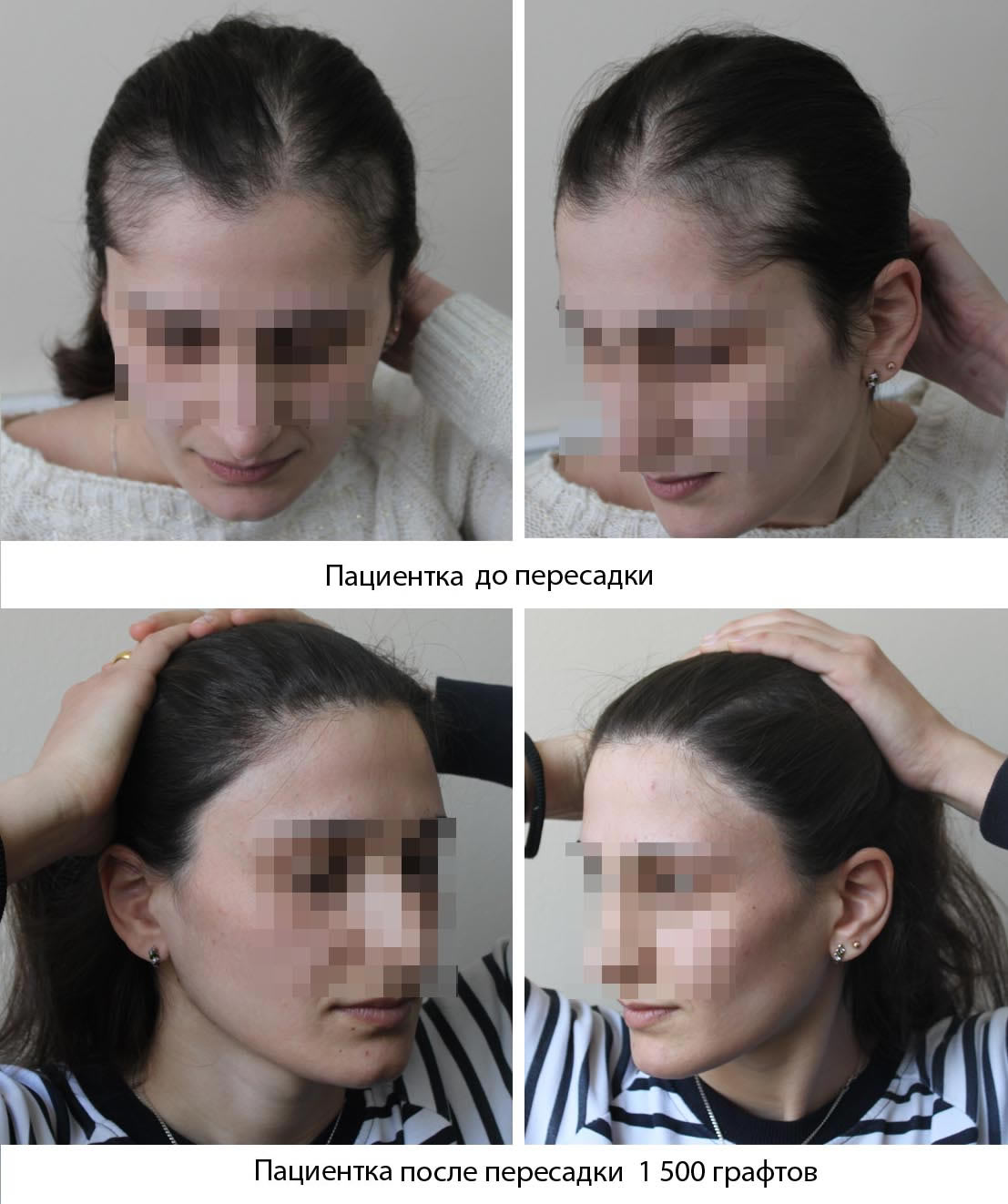 Пересадка волос у женщин -  до и после. Проф. Акакий Цилосани