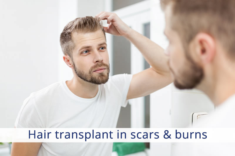 Hair transplant in scars & burns