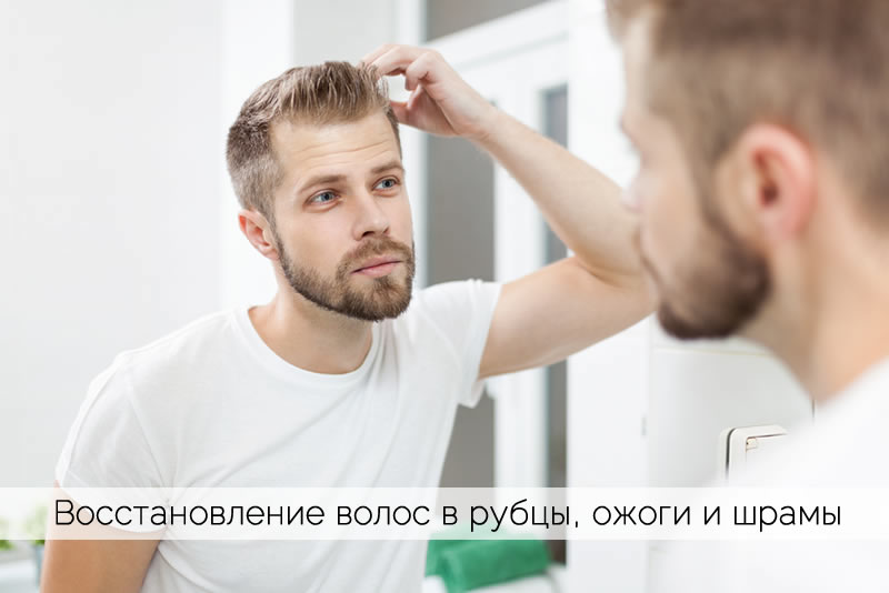 Пересадка волос в шрамы и рубцы. Проф. Акакий Цилосани