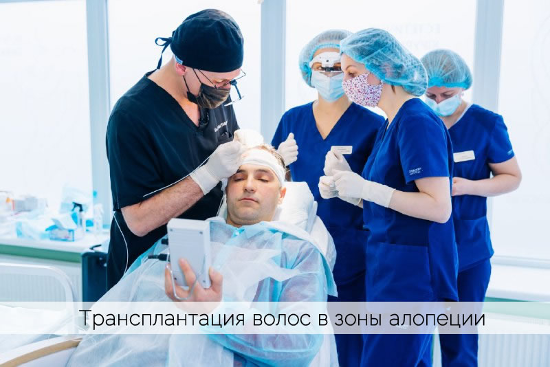 Восстановление волос в зоны алопеции. Проф. Акакий Цилосани
